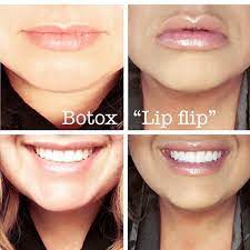 Youthful Medical Spa What S A Botox Lip Flip We Place Some Botox Above The Upper Lip To Turn It Upwards And Out This Is Great For Clients That Want The Look
