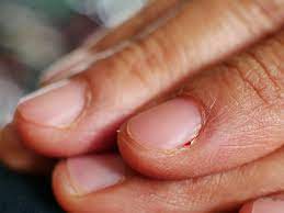 Paronychia is an infection of a hangnail on the finger. Nagelbettentzundung Was Jetzt Hilft