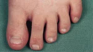 Image result for Onychotillomania feet