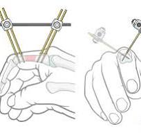 External fixation for Wedge/multifragmentary fracture of the ...