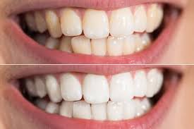 Best teeth whitening method 2021. The Beginner S Guide To Teeth Whitening Mcintosh Dental Centre