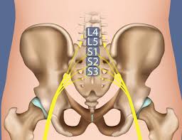 Sciatica originates in the lower back, radiates deep into posture induced symptoms. Sciatica Symptoms Diagnosis Treatment Miami Neuroscience Center