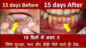 This type of discoloration can be prevented by making lifestyle adjustments or getting dental care. How To Whiten Yellow Teeth Gutka Teeth And Cigarette Stains From Teeth At Home Youtube