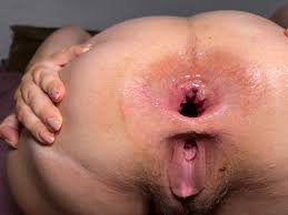 Double gape