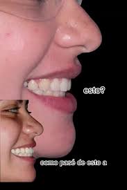 Casos Complicados de Ortodoncia: Antes y Después de Tratamientos