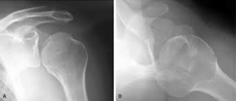 Image result for Chronic Shoulder Dislocation