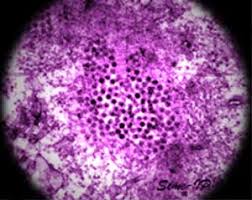 In prezent, sunt semnalate doua epidemii, in nordul greciei si in rusia, si cazuri izolate in romania. Virus Del Nilo Occidentale Wikipedia