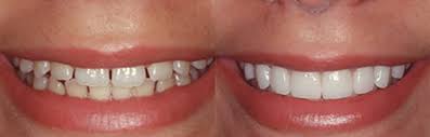 Valplast online dentures, tcs flexible partials Dental Veneers Cost Procedure And Results