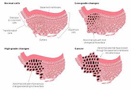 There are no screening options for detecting 4 out of 5 gynaecological cancers. Pin On Squamous Cell Carcinoma Of Cervix