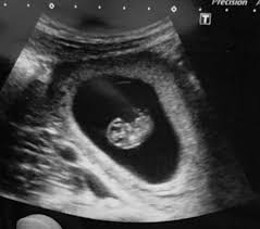 Early days your nhs pregnancy journey signs and symptoms of pregnancy health things you should know due date calculator week by week 4 to 8. Private Scan At 7 Weeks