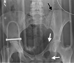 Surgical pelvic anatomy in gynecologic oncology. Pelvic Ring Fractures What The Orthopedic Surgeon Wants To Know Radiographics