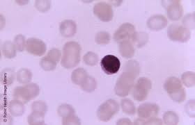Jeudi qu'il souffrait de leuc?mie lympho?de chronique. Leucemie Lymphoide Age Et Traitements Leucemie Lymphoide Chronique Medipedia