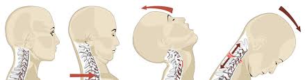 Whenever the neck is thrown out of. Whiplash From A Car Accident Everything You Need To Know