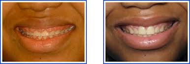 In order to correct gummy smile due to the above, gum surgery may be needed. Gummy Smile Treatment Long Island Esthetic Gum Contouring