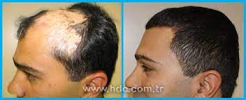 Yanik Sac Derisine Ozel Protez Sac Hdc Protez Sac
