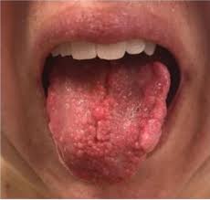 Image result for papillomavirus tongue)