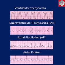 Image result for Synchronized Cardioversion