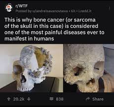 If the bone cancer is a cancer of the bone marrow such as multiple myeloma (and i've heard many myeloma patients use the term bone cancer to name their disease) i had stage 4 ovarian cancer, which had multiple metastases including in both lungs. Thanks I Hate Bone Cancer Gee Thanks I Hate It