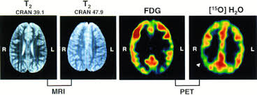 Cerebral Vasculopathy in Sickle Cell Anemia: Diagnostic Contribution of  Positron Emission Tomography