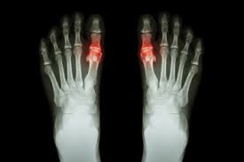 Image result for gout