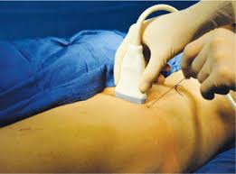 Lateral femoral cutaneous nerve block ultrasound. Ultrasound Guided Lateral Femoral Cutaneous Nerve Block Hadzic S Peripheral Nerve Blocks And Anatomy For Ultrasound Guided Regional Anesthesia 2nd