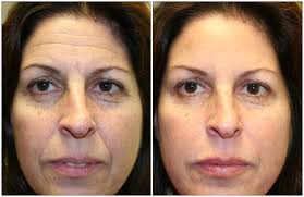 Lifestyle changes and home remedies will help in many. Get Rid Of Forehead Wrinkles The Skiny