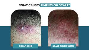 Image result for white scabs on the head in children