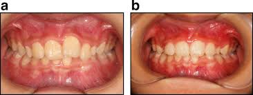 Image result for Tooth Avulsion