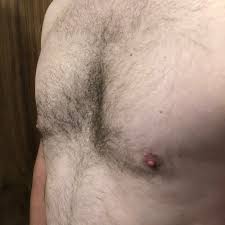 Chest wall deformity patient guidebook for ipad. Pectus Excavatum Surgery Implant Results Procedure Cost