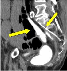 A colonic area 2 cm proximal to the anastomosis was transected. Oa Text Is An Independent Open Access Scientific Publisher Showcases Innovative Research And Ideas Aimed At Improving Health By Linking Research And Practice To The Benefit Of Society