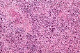 Image result for Microscopic Polyangiitis