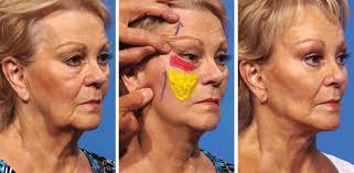 Left) Preoperative appearance. (Center) Demonstration of the goal of...