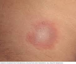 Erythema migrans or erythema chronicum migrans is an expanding rash often seen in the early stage of lyme disease, and can also (but less. Lyme Disease Symptoms And Causes Mayo Clinic