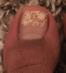 Help I Took Off My Nail Polish And Now I Think I Have A Fungus Dr Shyla Arya At Foot And Ankle Associates Of North Tex Toenail Fungus My Nails