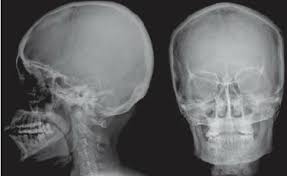Image result for Skull XRay