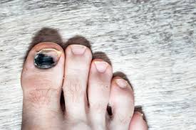 Image result for black toe diabetes