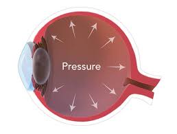 Image result for Intraocular Pressure