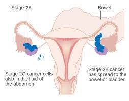 Confirmed spread to the peritoneum outside the pelvis and/or metastasis to the retroperitoneal lymph nodes old new iiia microscopic. File Diagram Showing Stage 2a To 2c Ovarian Cancer Cruk 214 Svg Wikimedia Commons