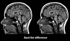 .advances and genetic research that link brain science to behavior—all leading to a route toward more effective mainstreaming and a way to unleash the unique advantages of autistic people. Most Autistic People Have Normal Brain Anatomy Discover Magazine