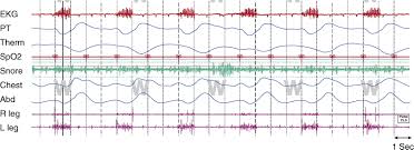 Image result for Polysomnogram