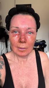 Recovery Precision Tx Laser