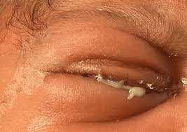 Image result for Gonococcal Conjunctivitis