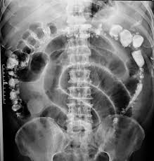Posoperado Ca Colon Ileo Paralitico Diverticulo Colon Ascendente Y Descendente Radiologia Ascendente Y Descendente
