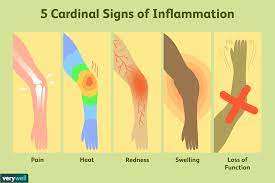 Many times there is no perceptible symptom present. What Are The 5 Cardinal Signs Of Inflammation