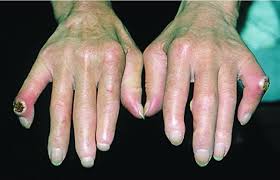 Educational image placeholder: Raynaud's phenomenon and finger changes in systemic sclerosis