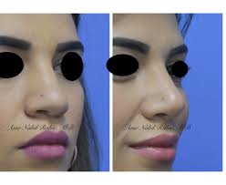 Cairo Rhinoplasty Clinic Dr Amr Nabil Rabie