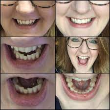 This link is to an external site that may or may not meet accessibility guidelines. Reviews And Results Smiledirectclub Smiledirectclub Dental Braces Braces Alternative