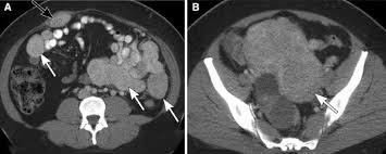 Can ovarian cancer be found early? Ovarian Cancer Mimics How To Avoid Being Fooled By Extraovarian Pelvic Masses Springerlink