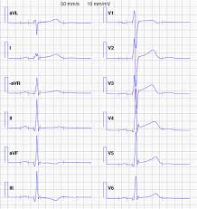 Image result for Early Repolarization