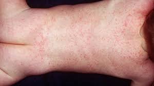 Image result for vyrážka u dětí